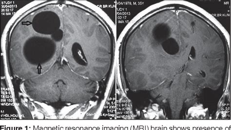 Figure 1 From Primary Intracranial Multiple Hydatid Cysts In An Adult