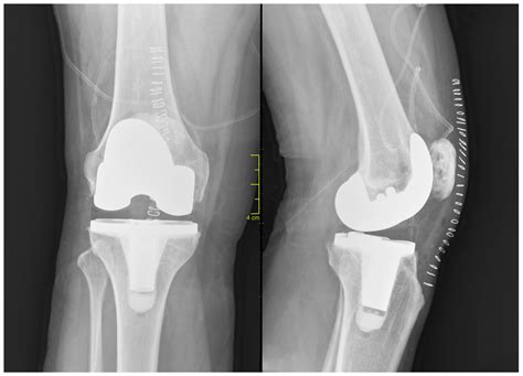 When is it time for knee surgery? Here are some pros, cons