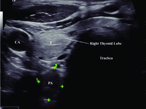 Parathyroid Ultrasound Anatomy