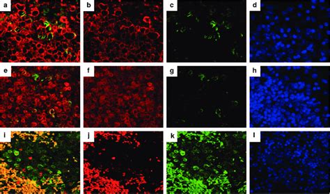 Dual Immunofluorescence Staining For Cd Bcl And Bcl With Lmp In