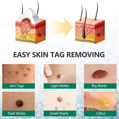 Skin Tag Remover Ointment 20g Elaimei