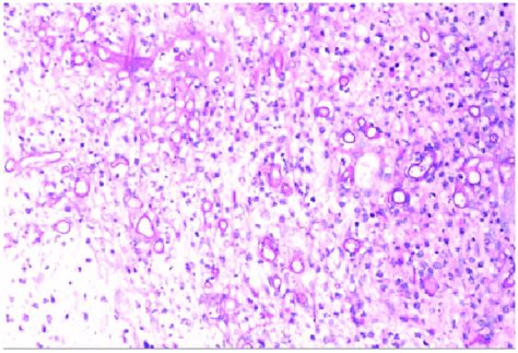 Gomori Methenamine Silver Staining Positive Download Scientific Diagram