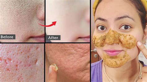 7 Days Challenge Get Rid Of OPEN PORES LARGE PORES CLOGGED PORES