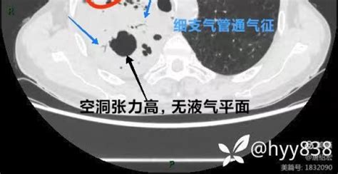 如何在肺 Ct 上一眼识别致病菌？ 读片挑战第 22 弹腾讯新闻