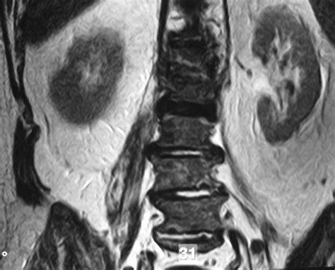 Case No Ap Mri Of The Affected Lumbar Spine Showing Psoas Abscess