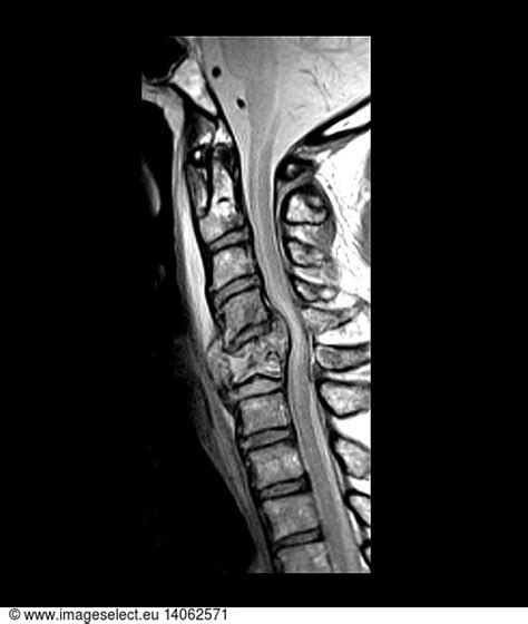 Cervical Spine Fracture Cervical Spine Fracture, MRI,abnormal,cervical ...