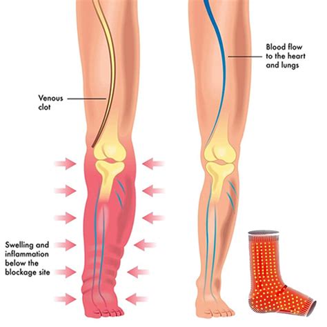 NeoCare Anti Ankle Edema Socks - Wizzgoo.com