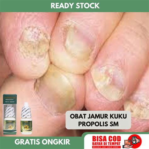 Obat Jamur Kuku Obat Kuku Busuk Dan Berjamur Obat Kuku Rusak Herbal