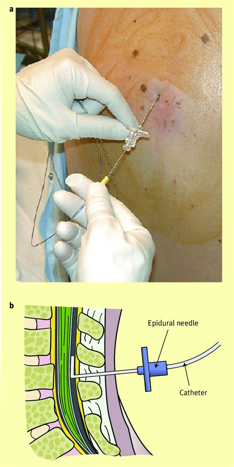 A Placement Of A Thoracic Epidural An Indwelling Catheter Is Threaded