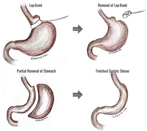 Revision Gastric Sleeve Surgery at Rs 720000/piece in Raigad | ID: 10608330433