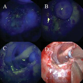 Intraoperative View After First Indocyanine Green Icg Injection A