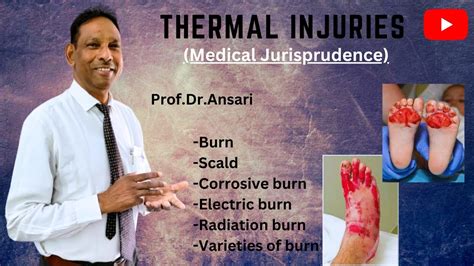 Thermal Injuries Burn Scald Electric Burn Radiation Burn