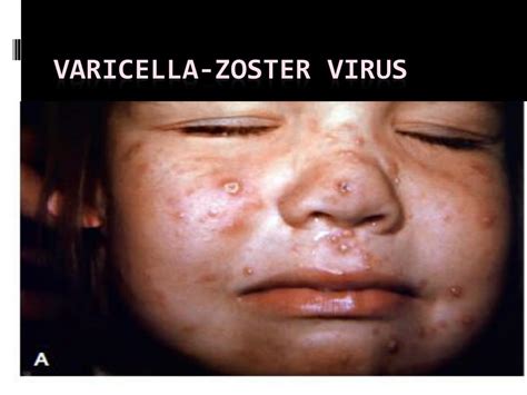 PPT - Varicella -zoster virus PowerPoint Presentation, free download ...