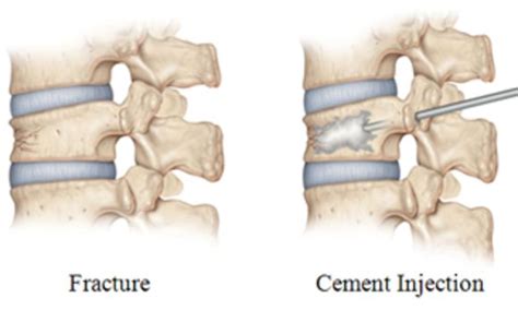 Kyphoplasty For Treating Vertebral Compression Fractures By Medical