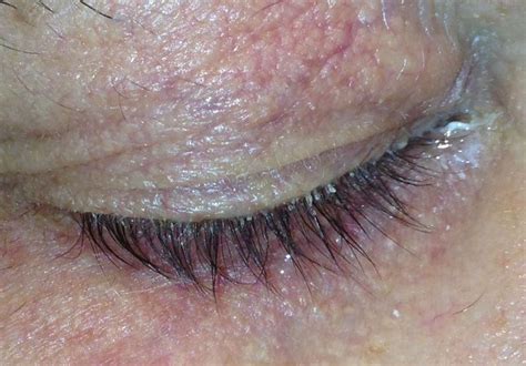 Демодекоз век: схема лечения, симптомы и причины