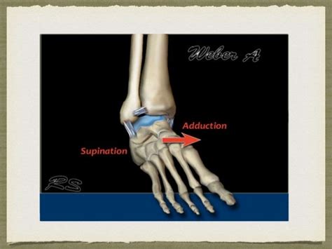 syndesmotic injury mechanism and treatment subject review