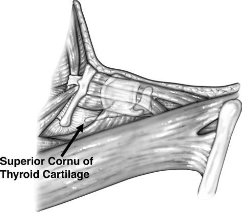 Arytenoid Abduction For Bilateral Vocal Fold Paralysis Operative