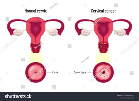 Comparison Normal Cervix Cervical Cancer Cervix Stock Vector Royalty