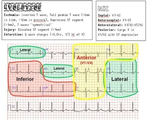 Ekg Interpretation Made Easy Ekg Icu Nursing Cardiac Nursing