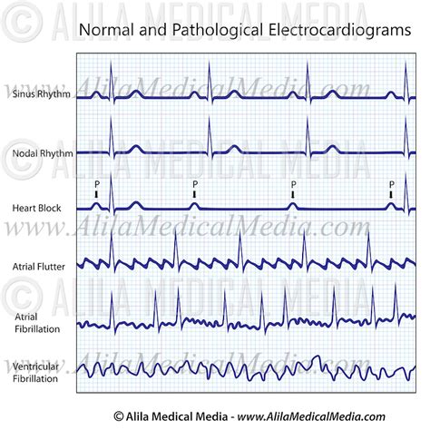 Ekg Strip Labeled