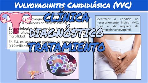 VULVOVAGINITIS CANDIDIÁSICA Síntomas Diagnóstico y Tratamiento