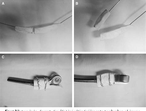 Figure From A New Technique For Management Of Ulnar Bone Loss In