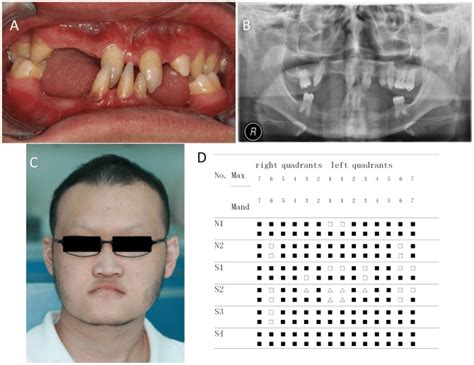 A Clinical Phenotype Of Patient S2 Showing Congenital Tooth Agenesis