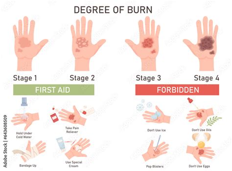 Degree of skin burn infographic poster with first aid and forbidden ...