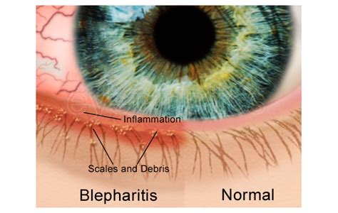 Blepharitis Boise Eyelid Inflammation Idaho