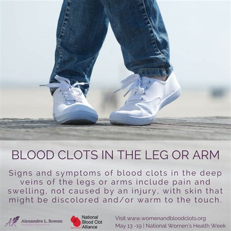 Rt Share This Know The Signs And Symptoms Of Blood Clots In Your Leg