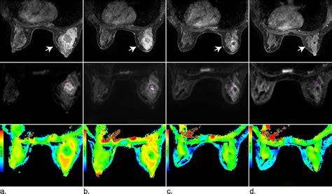 Mri Images Of A 49 Year Old Woman With Invasive Breast Cancer Who