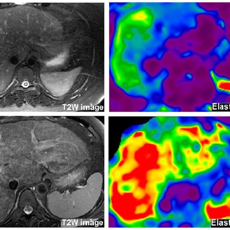 Magnetic Resonance Elastography Images To Measure Liver Stiffness In