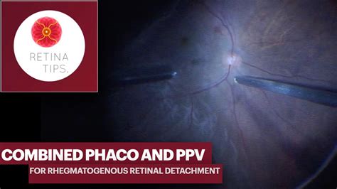 Combined Phaco And Vitrectomy For Rhegmatogenous Retinal Detachment