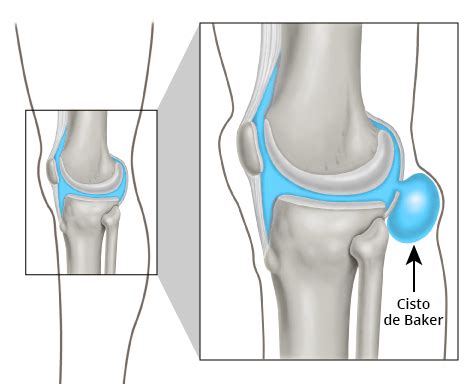 Cisto de Baker e agora Oncologia Ortopédica