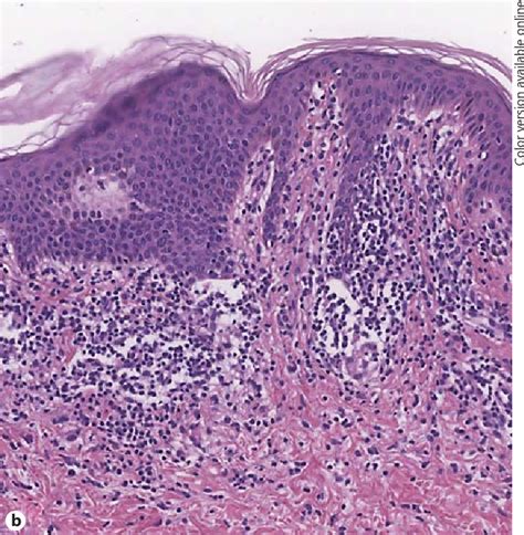 Figure 2 From Annular Lichenoid Dermatitis Of Youth Report Of Six New