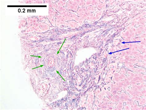 Primary Sclerosing Cholangitis Libre Pathology