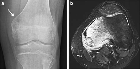 Chondroblastoma