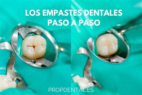 ¿cómo Se Realiza Un Empaste Dental Paso A Paso Del Empaste Dental