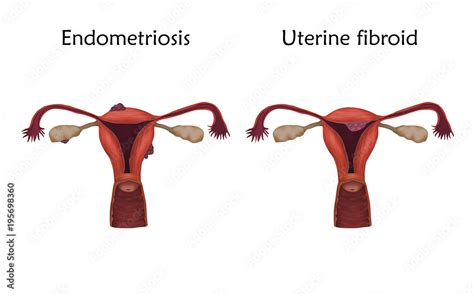 Endometriosis And Uterine Fibroid Human Realistic Uterus Anatomy