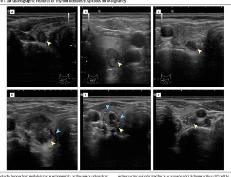 Figure 1 From The Diagnosis And Management Of Thyroid Nodules A Review