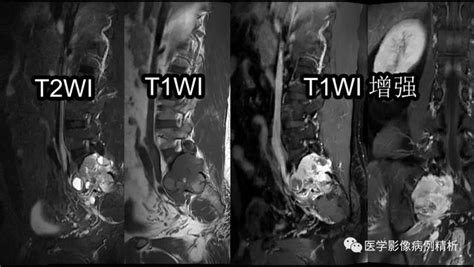 Mr平扫增强对骶椎良恶性肿瘤的鉴别诊断并一例骨巨细胞瘤合并动脉瘤样骨囊肿典型病例探讨、报告书写范例（全文） 知乎