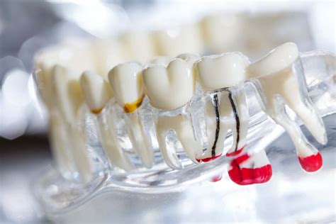 Myths And Facts About Root Canals What You Need To Know Dental Inc