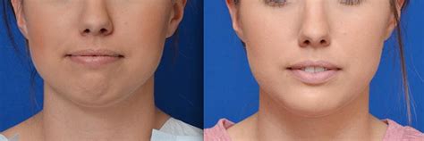 Chin Augmentationreduction Genioplasty In Delhi Plastic Surgery Ncr