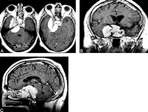 The Orbitozygomatic Combined Supra And Infratentorial Approach