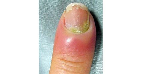 paronychia archives wwwmedicoappsorg