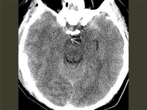 Brain herniation imaging