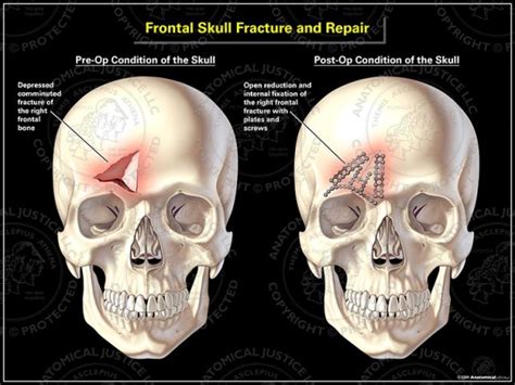 Frontal Skull Fracture And Repair