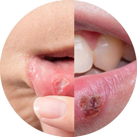 Canker Sore Vs Cold Sore Inside Lip