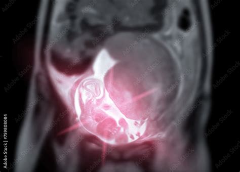 Mri During Pregnancy Ensures Non Invasive Evaluation Of Fetal Health