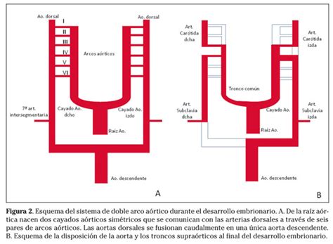 Arco aórtico derecho divertículo de Kommerell y arteria subclavia